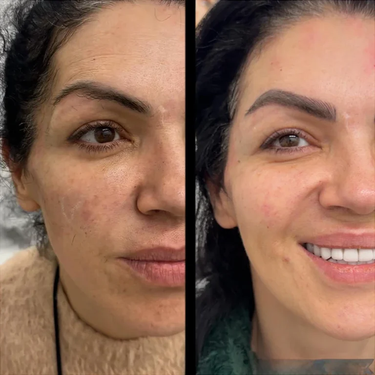 Temple filler before and after – front view – Paris Clinic London – Model 1
