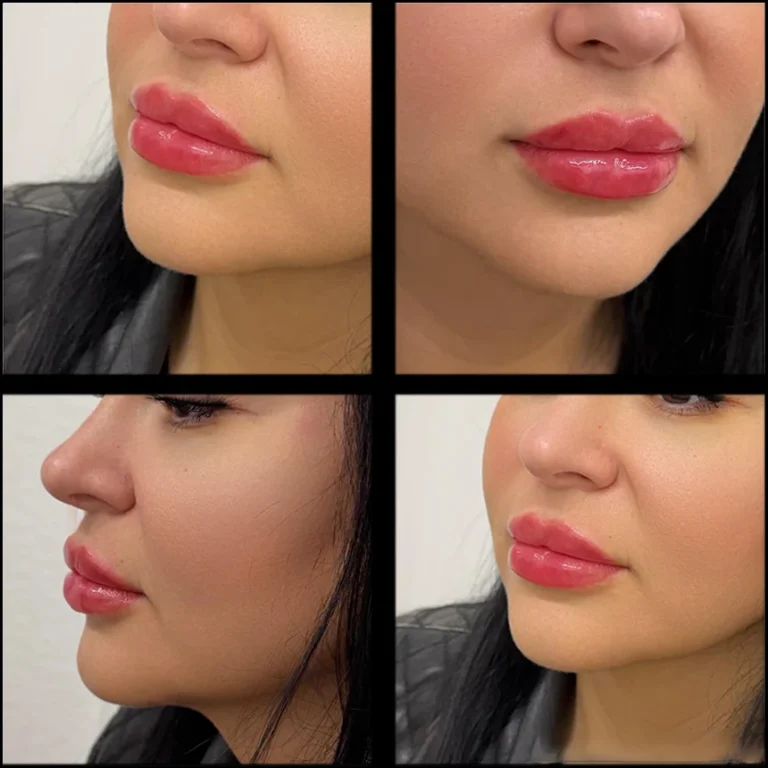 Lip filler results – multi-view (front, left side, right side, close-up) – Paris Clinic London – Model 1