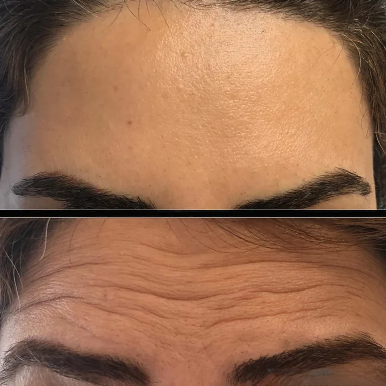 Anti wrinkle treatment Forehead botox before and after – front view – Paris Clinic London – Model 1