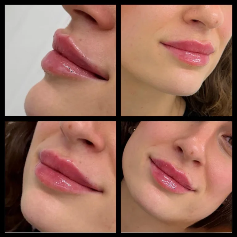 Lip filler treatment outcome – multi-view (front, left profile, right profile, close-up) – Paris Clinic London – Model 2
