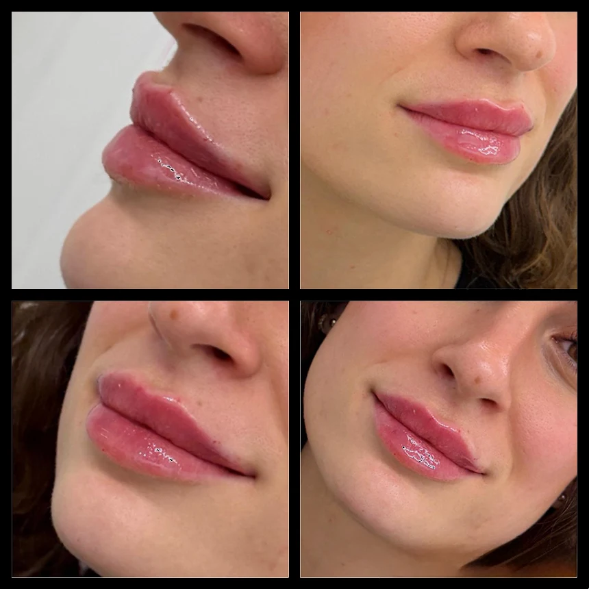 Lip filler treatment outcome – multi-view (front, left profile, right profile, close-up) – Paris Clinic London – Model 2